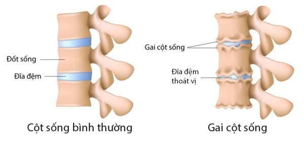 Gai cột sống