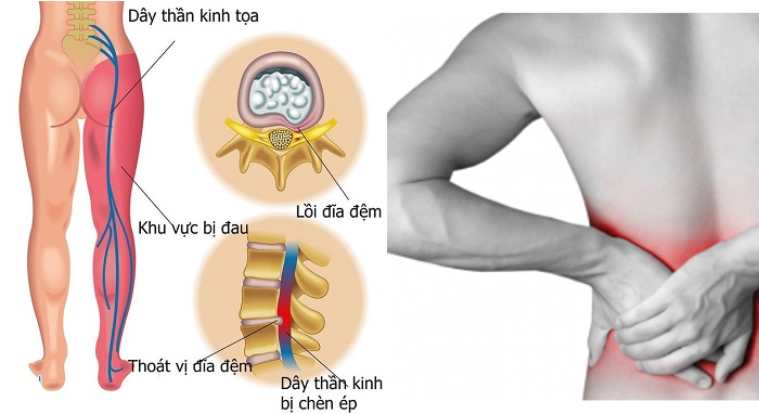 Thoát vị đĩa đệm